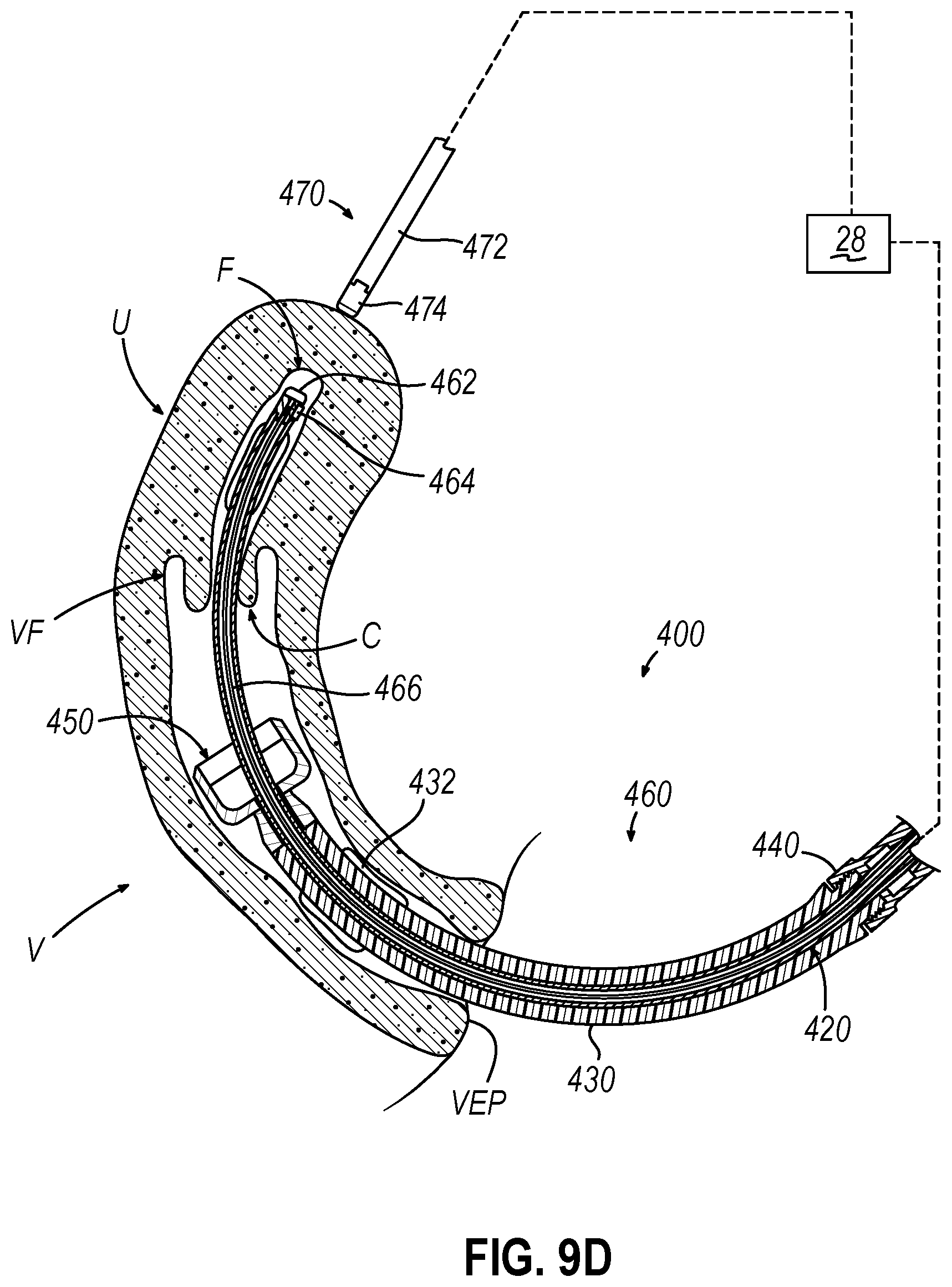 Patent US12599407 Figure 15 – System and method to measure uterine wall thickness