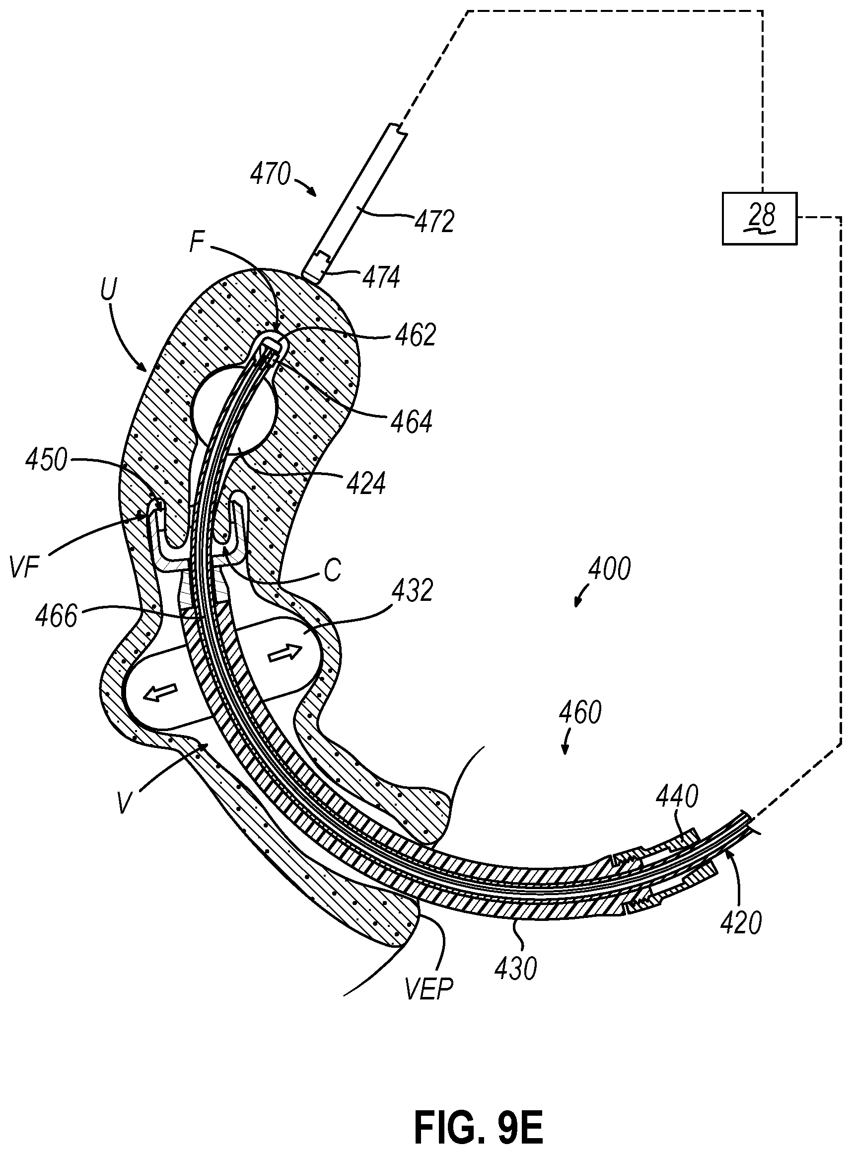 Patent US12599407 Figure 16 – System and method to measure uterine wall thickness