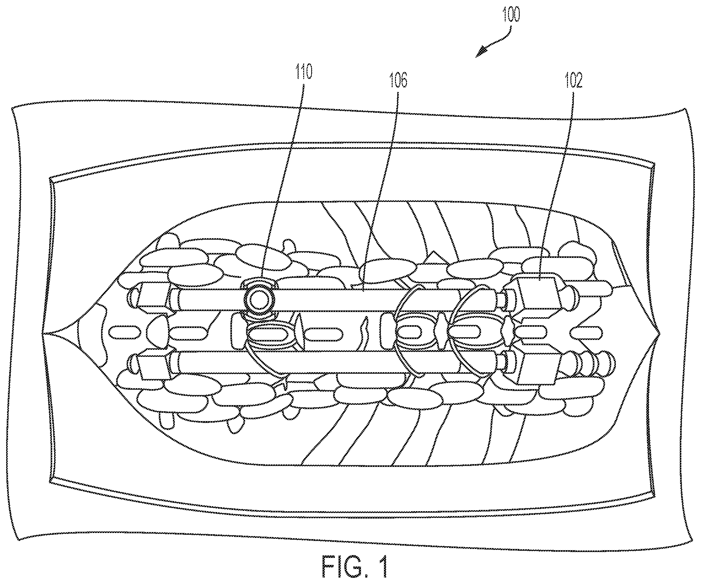 Patent US12599412 Figure 1 – Intra-operative options for smart implants