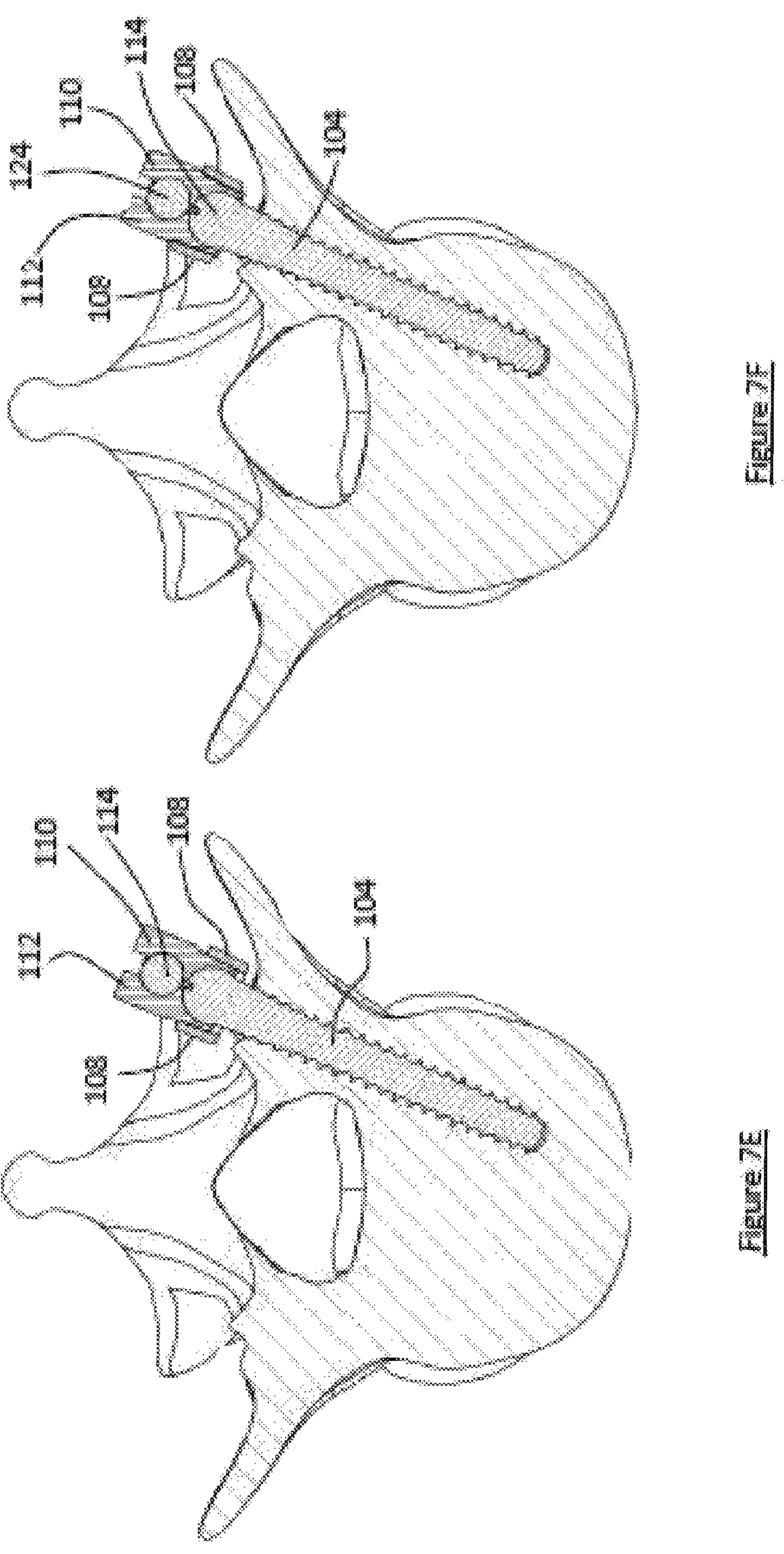 Patent US12599413 Figure 9 – Composite material spinal implant
