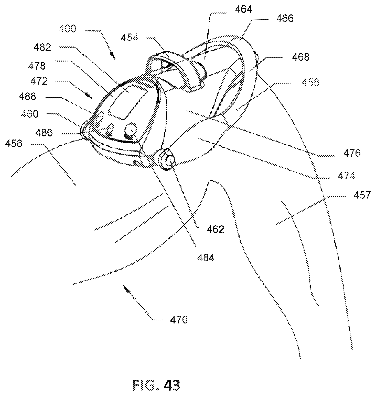Patent US12599416 Figure 15 – Adjustable implant