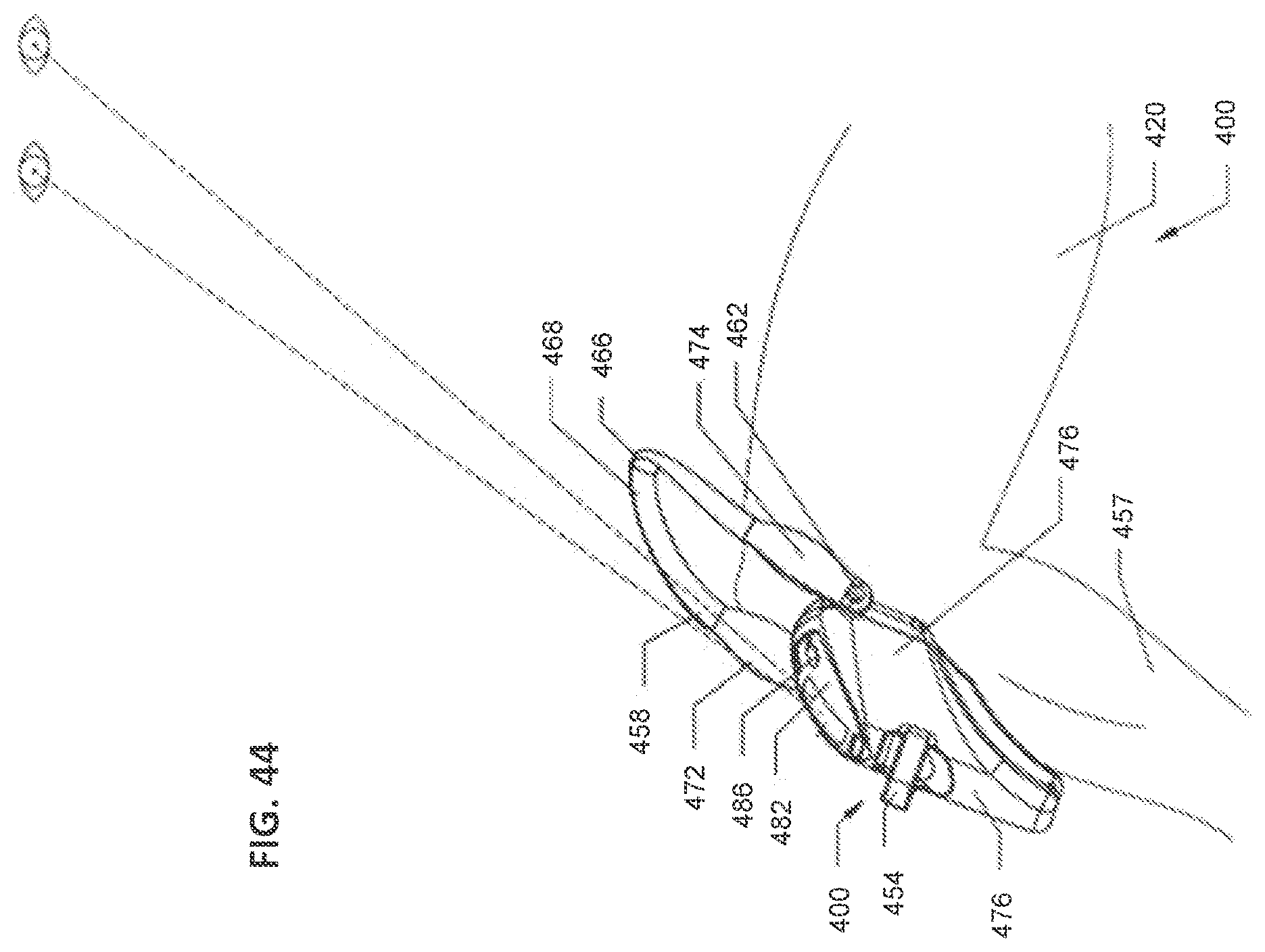 Patent US12599416 Figure 16 – Adjustable implant