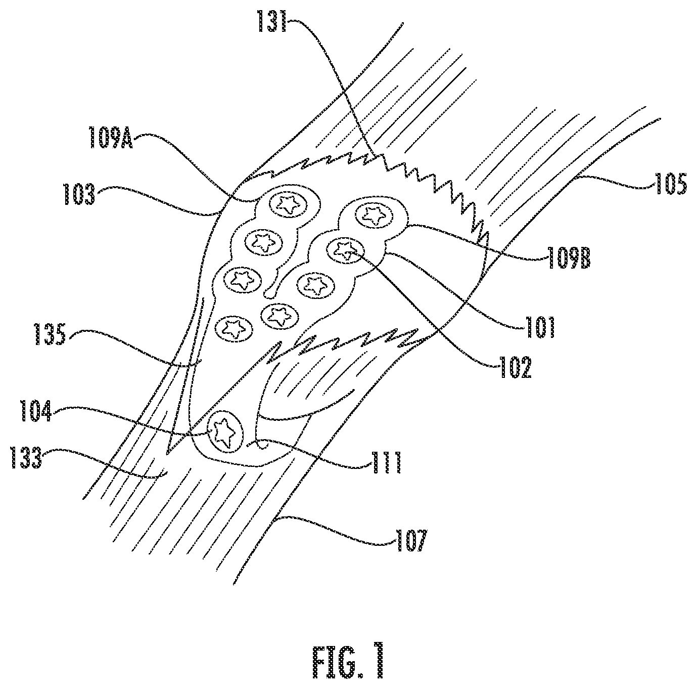 Patent US12599417 Figure 1 – Patella bone plate systems