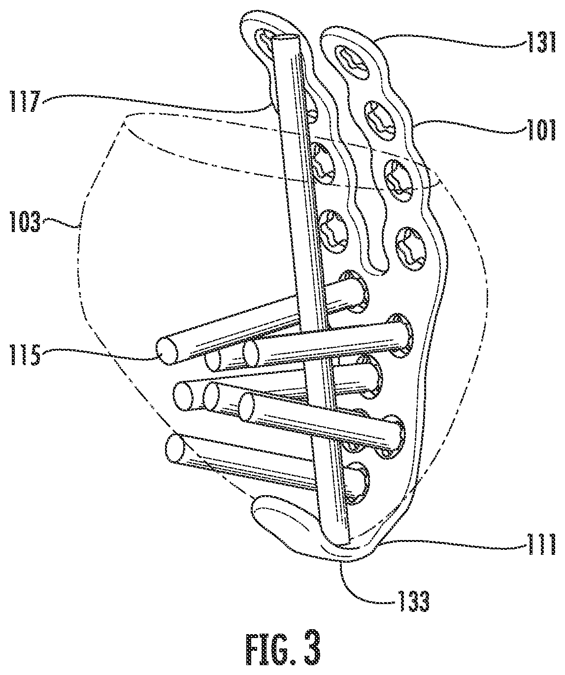 Patent US12599417 Figure 3 – Patella bone plate systems