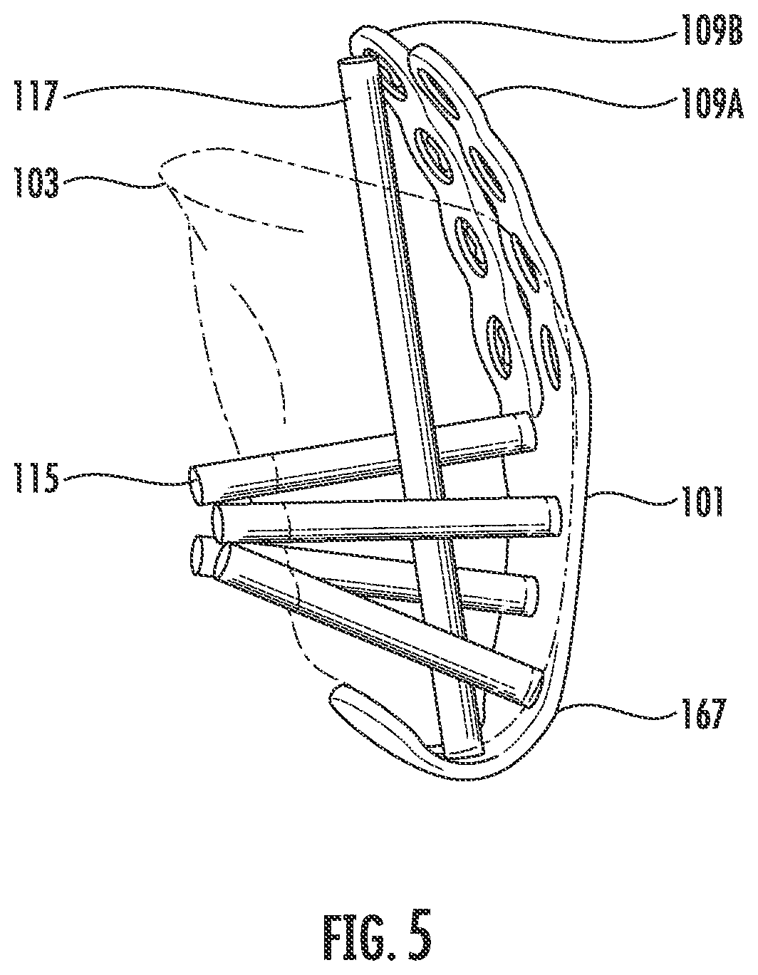 Patent US12599417 Figure 5 – Patella bone plate systems