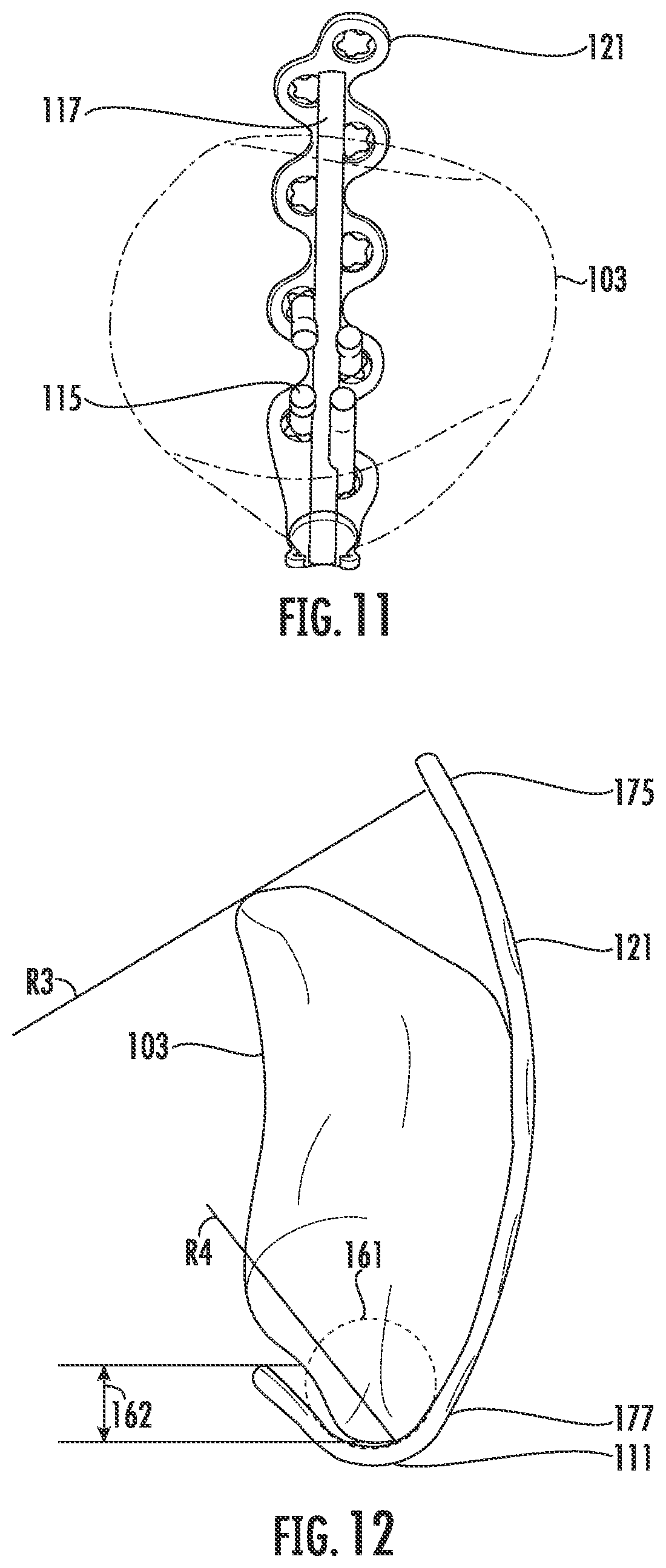 Patent US12599417 Figure 9 – Patella bone plate systems