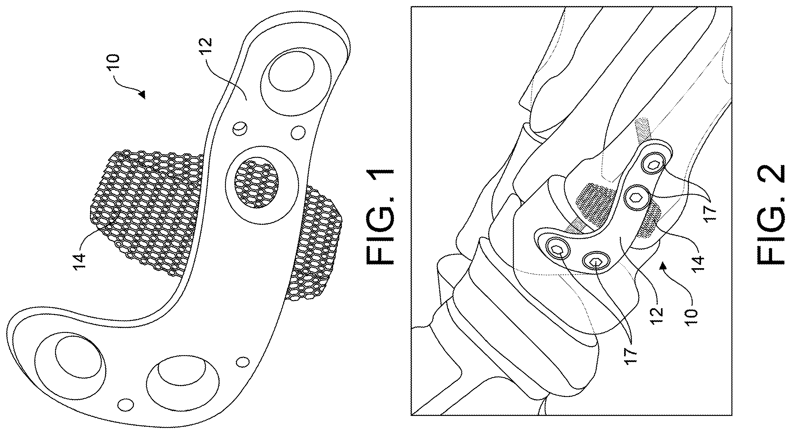 Patent US12599418 Figure 1 – Bone fixation devices