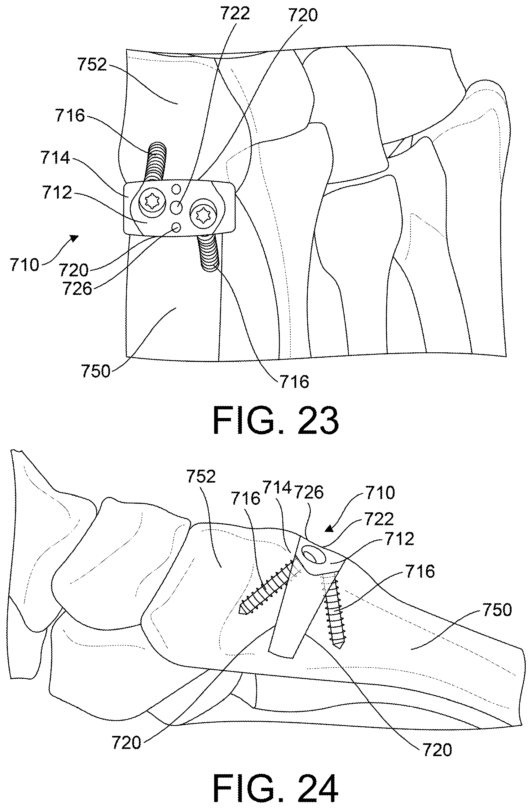 Patent US12599418 Figure 9 – Bone fixation devices