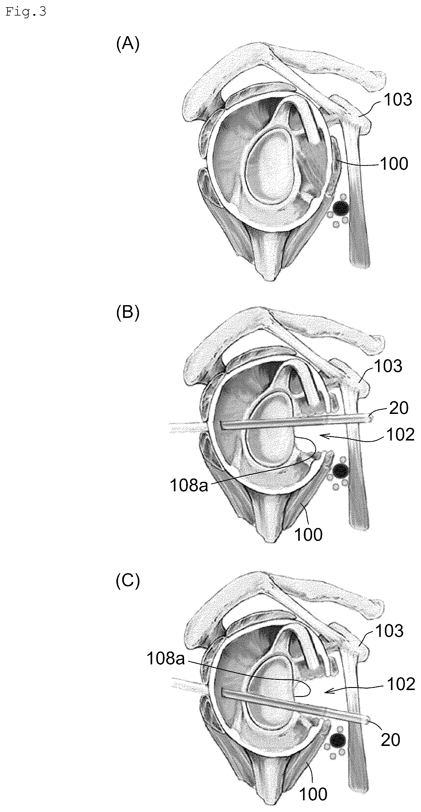 Patent US12599420 Figure 3 – Surgical instrument, medical tool set, and movement method