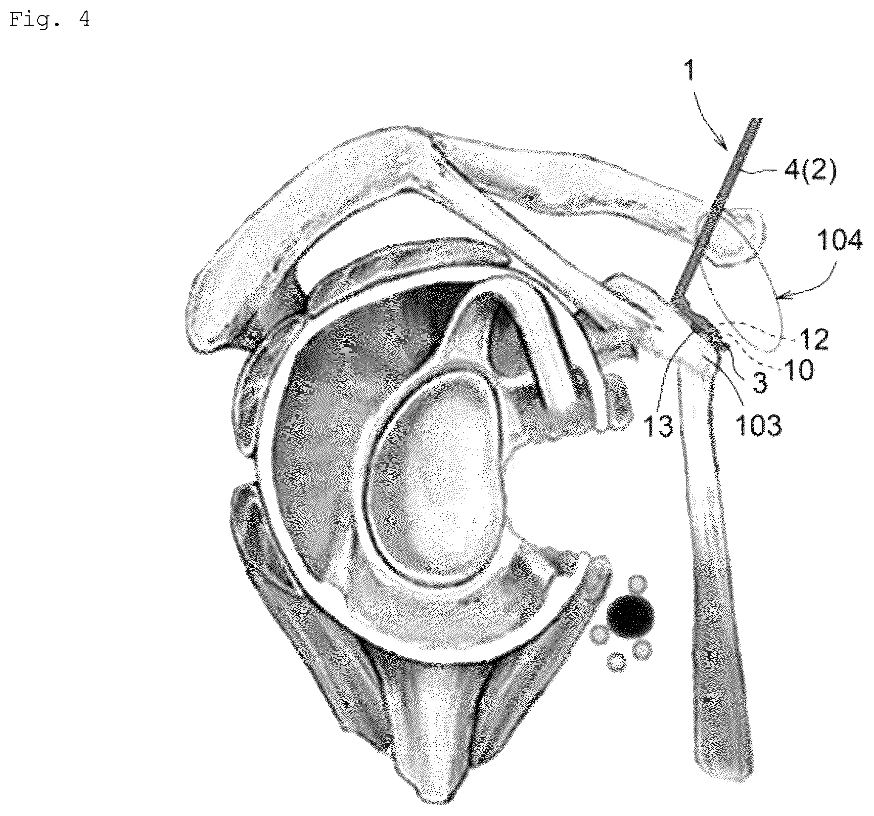 Patent US12599420 Figure 4 – Surgical instrument, medical tool set, and movement method