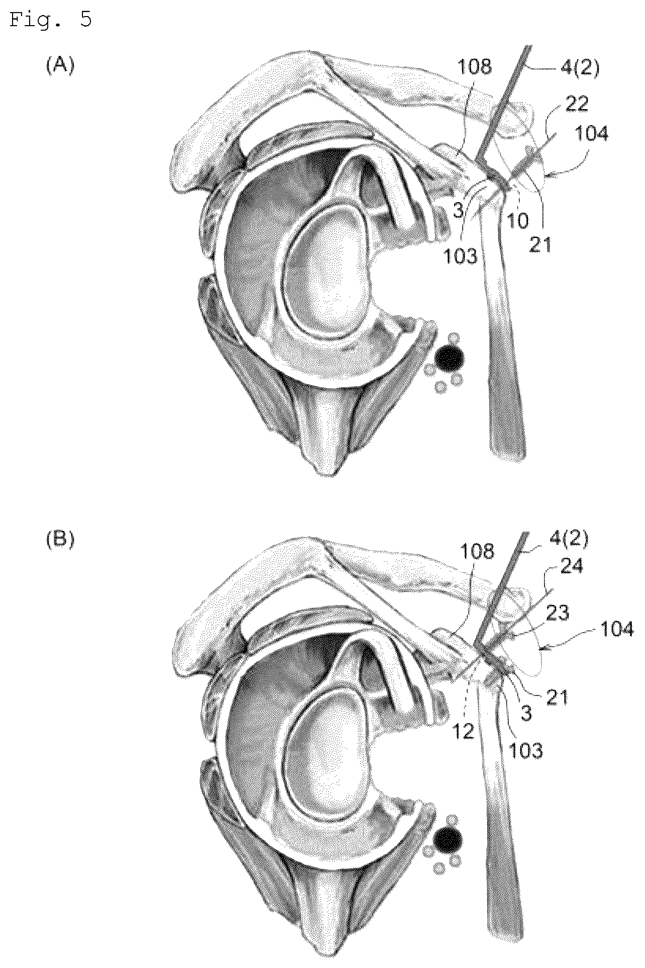 Patent US12599420 Figure 5 – Surgical instrument, medical tool set, and movement method