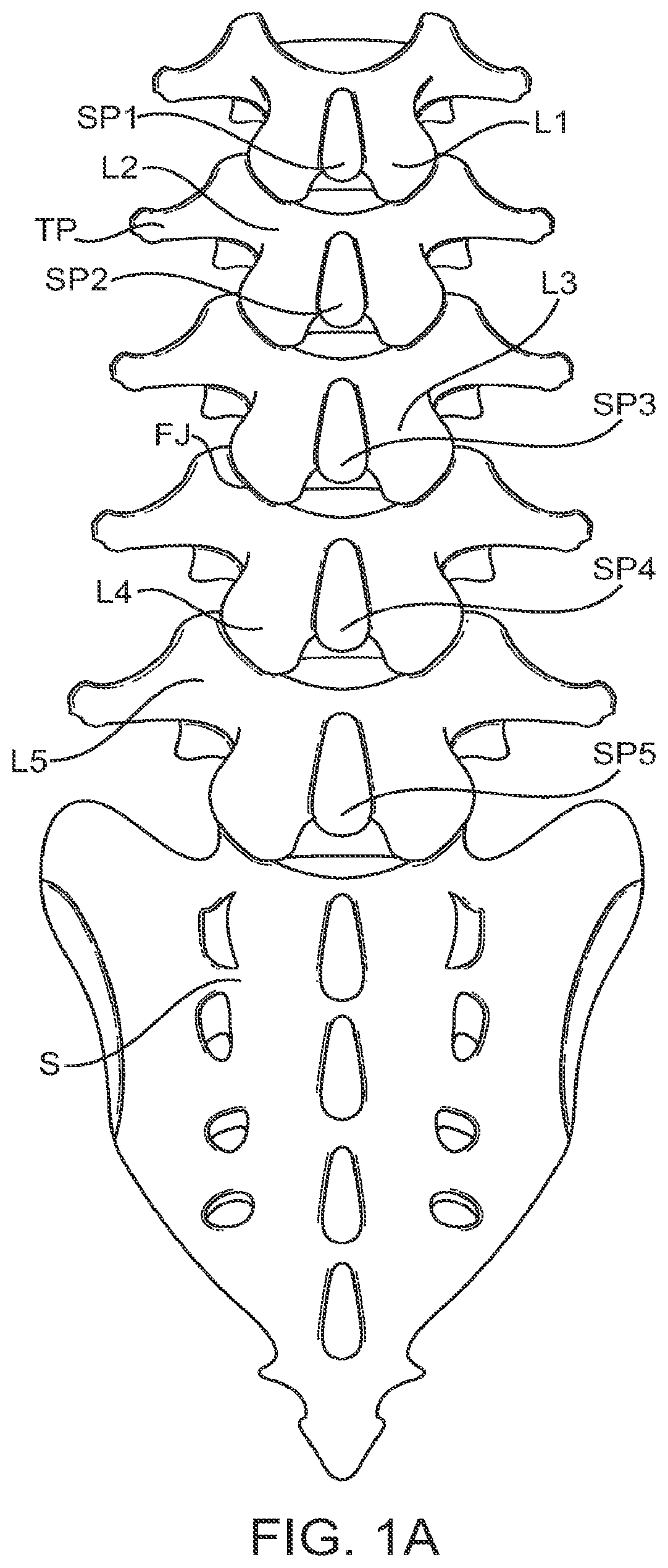Patent US12599421 Figure 1 – Sacral tether anchor and methods of use