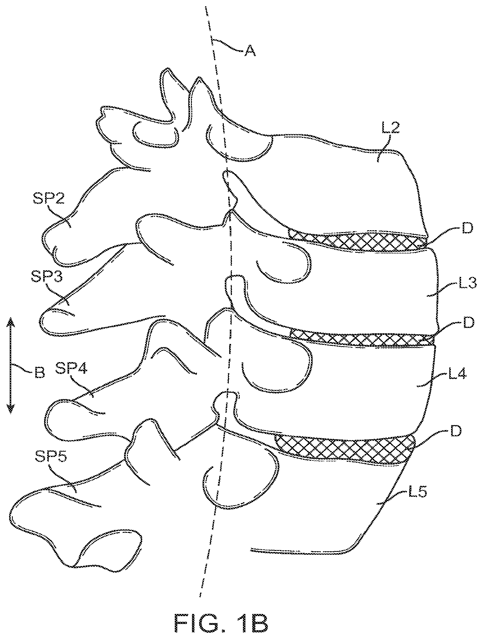 Patent US12599421 Figure 2 – Sacral tether anchor and methods of use