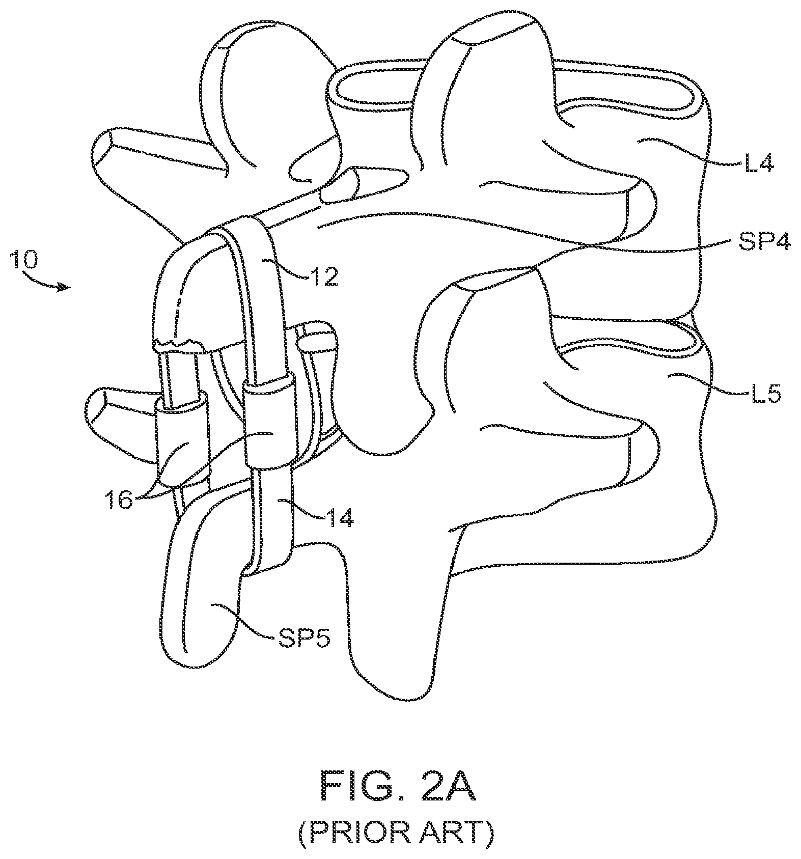 Patent US12599421 Figure 3 – Sacral tether anchor and methods of use