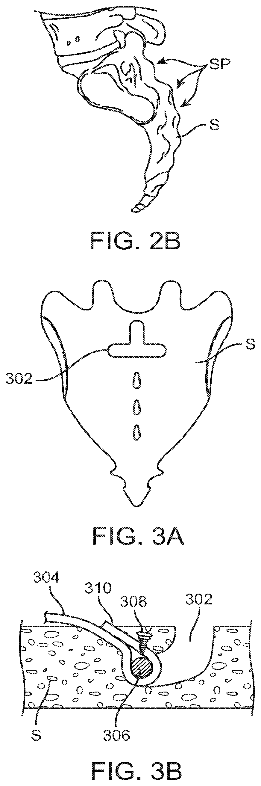 Patent US12599421 Figure 4 – Sacral tether anchor and methods of use