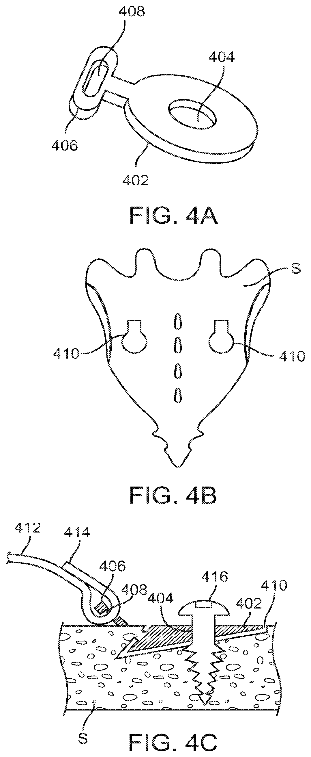 Patent US12599421 Figure 5 – Sacral tether anchor and methods of use