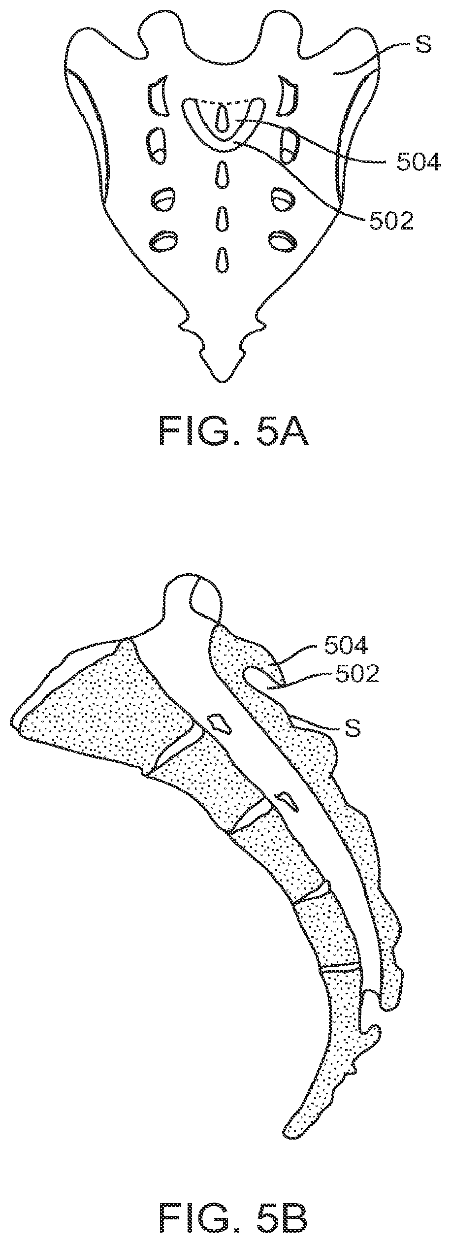 Patent US12599421 Figure 6 – Sacral tether anchor and methods of use