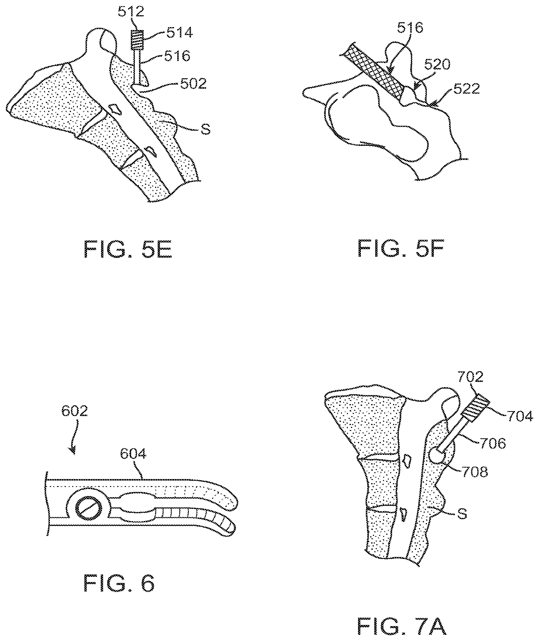 Patent US12599421 Figure 8 – Sacral tether anchor and methods of use