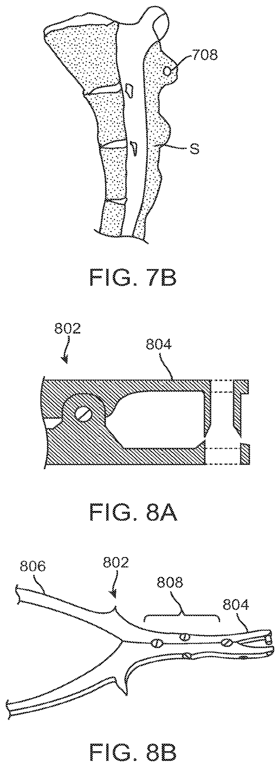 Patent US12599421 Figure 9 – Sacral tether anchor and methods of use