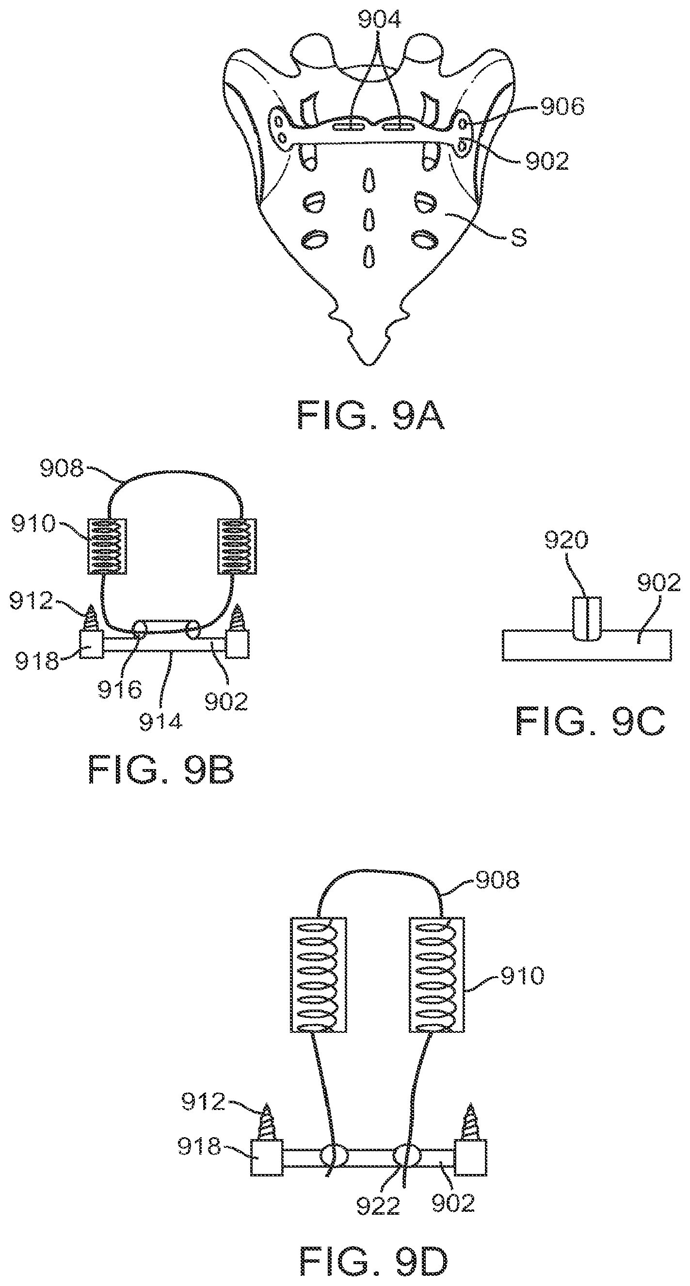 Patent US12599421 Figure 11 – Sacral tether anchor and methods of use
