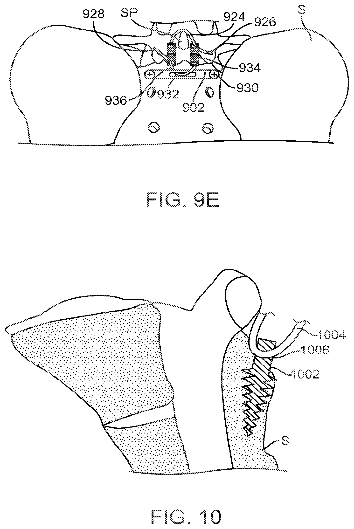 Patent US12599421 Figure 12 – Sacral tether anchor and methods of use