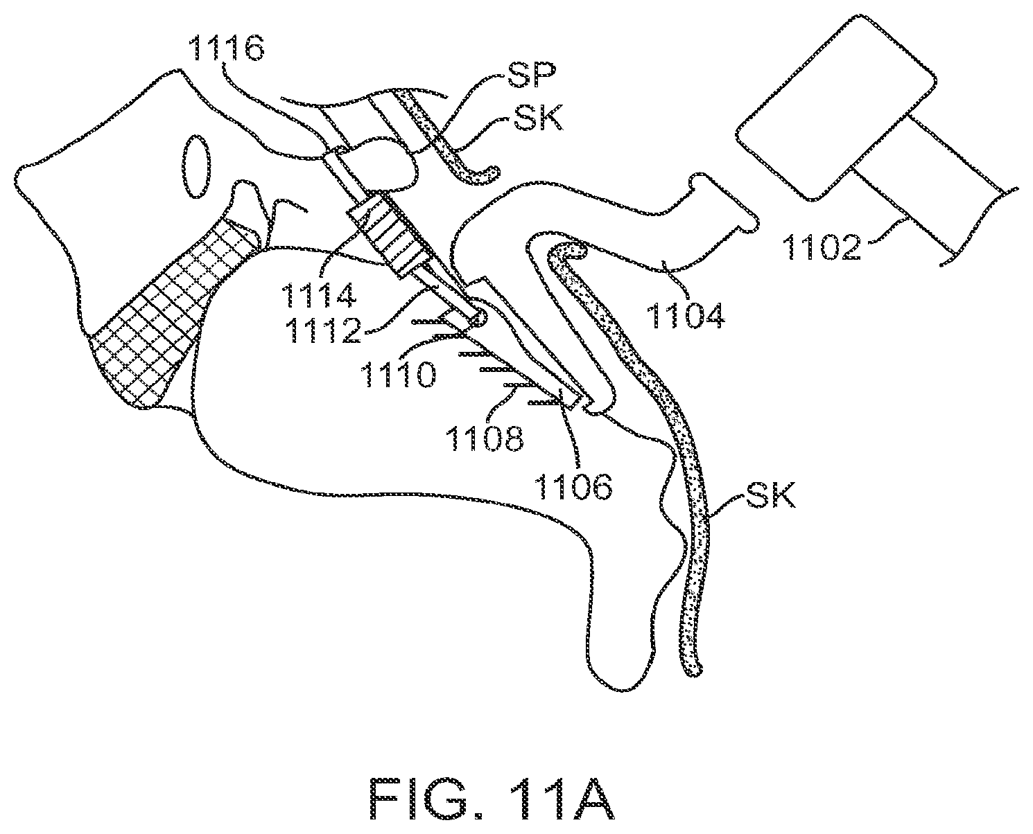 Patent US12599421 Figure 13 – Sacral tether anchor and methods of use