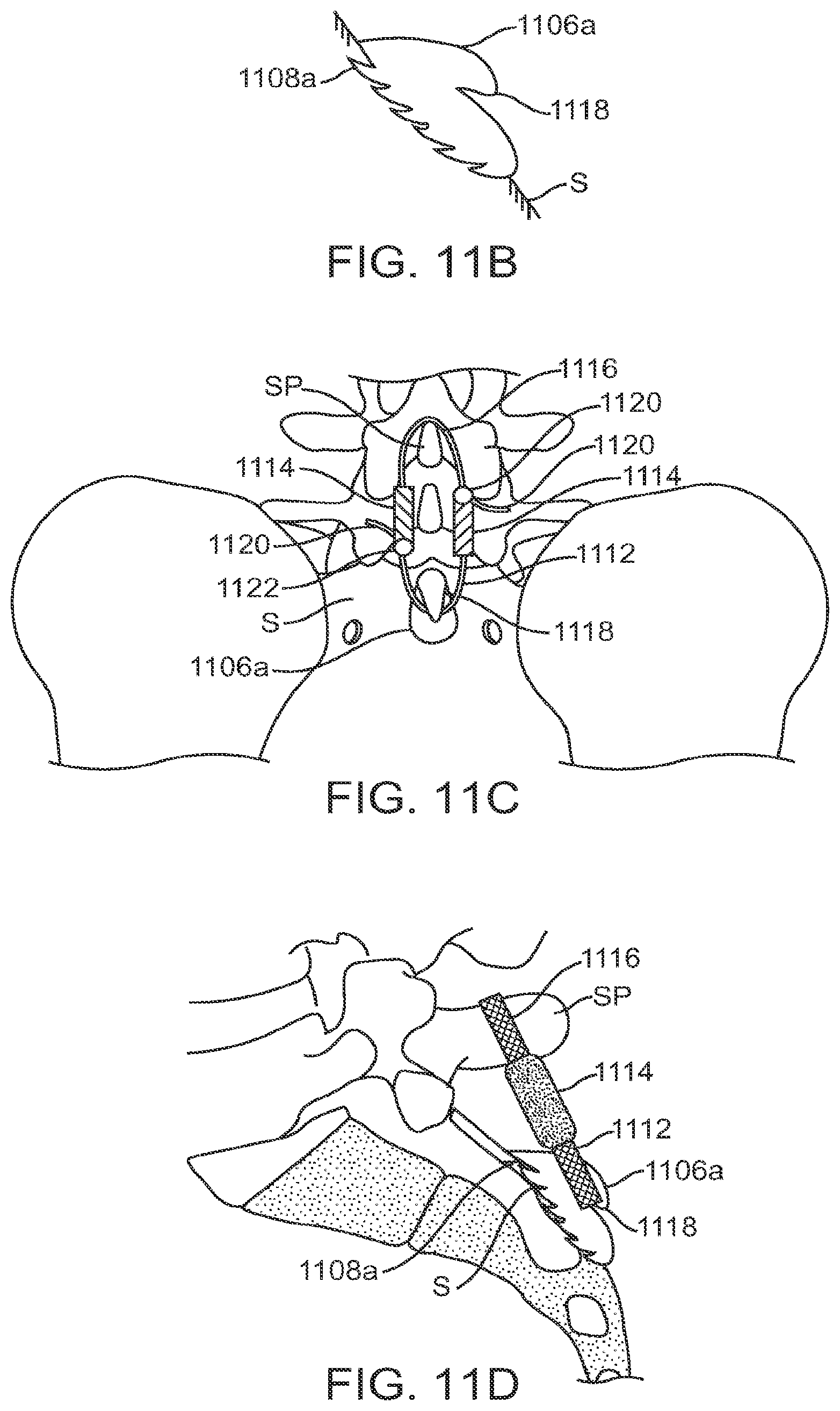 Patent US12599421 Figure 14 – Sacral tether anchor and methods of use