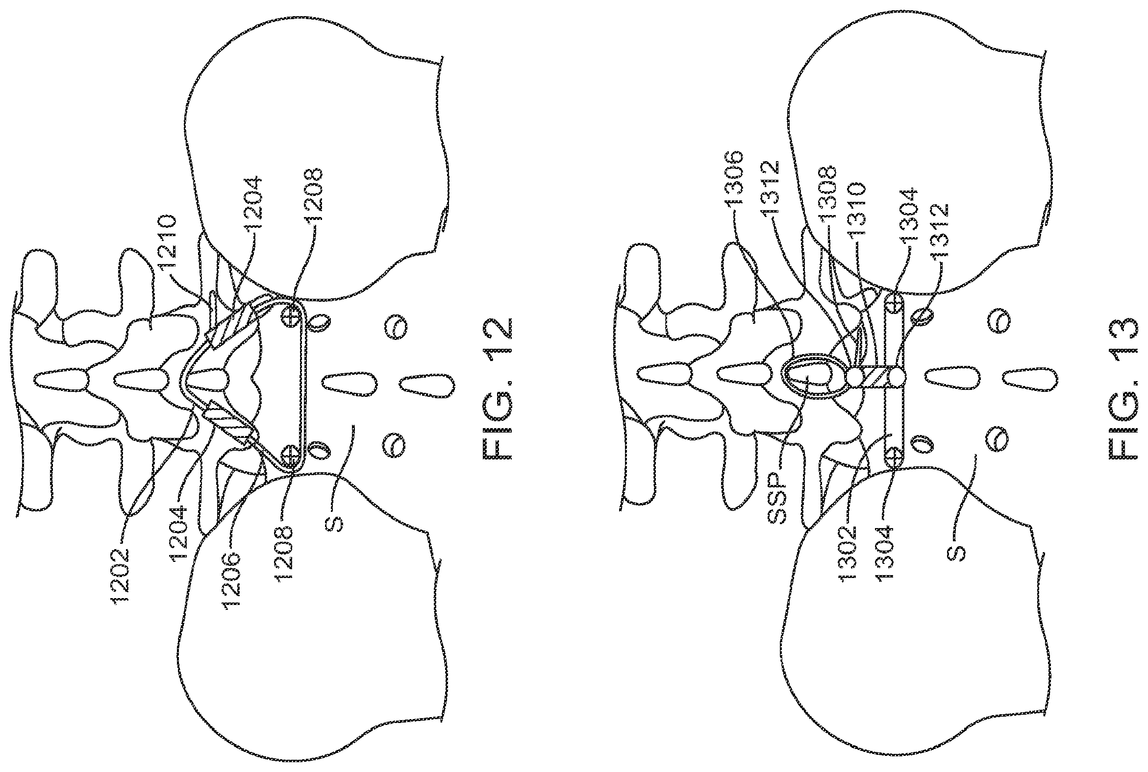 Patent US12599421 Figure 15 – Sacral tether anchor and methods of use