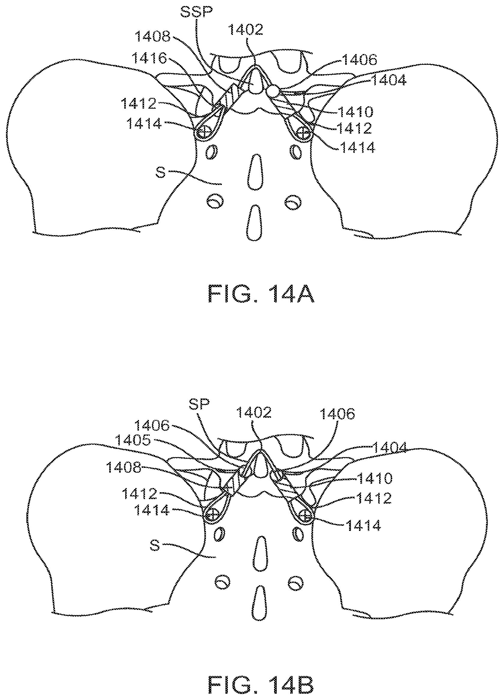 Patent US12599421 Figure 16 – Sacral tether anchor and methods of use