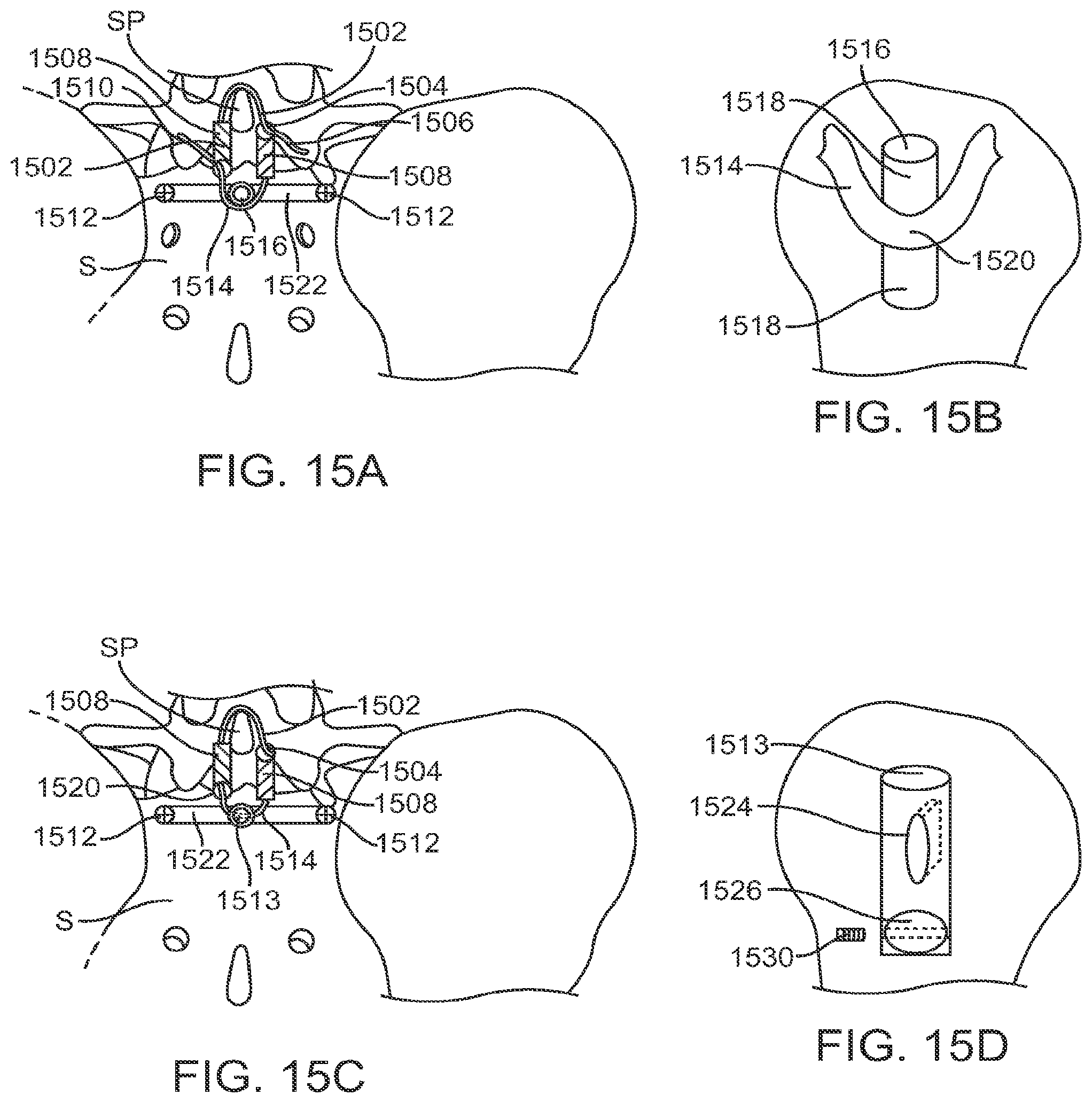 Patent US12599421 Figure 17 – Sacral tether anchor and methods of use