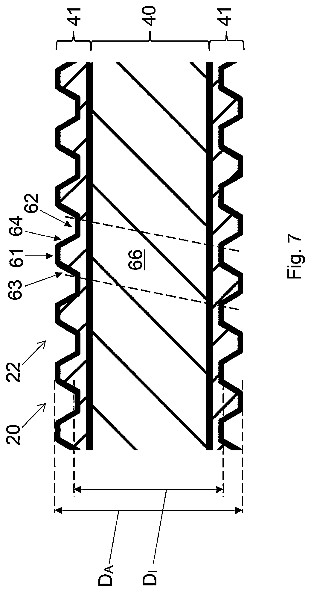 Patent US12599423 Figure 5 – Apparatus for pressing out bone cement, use and system