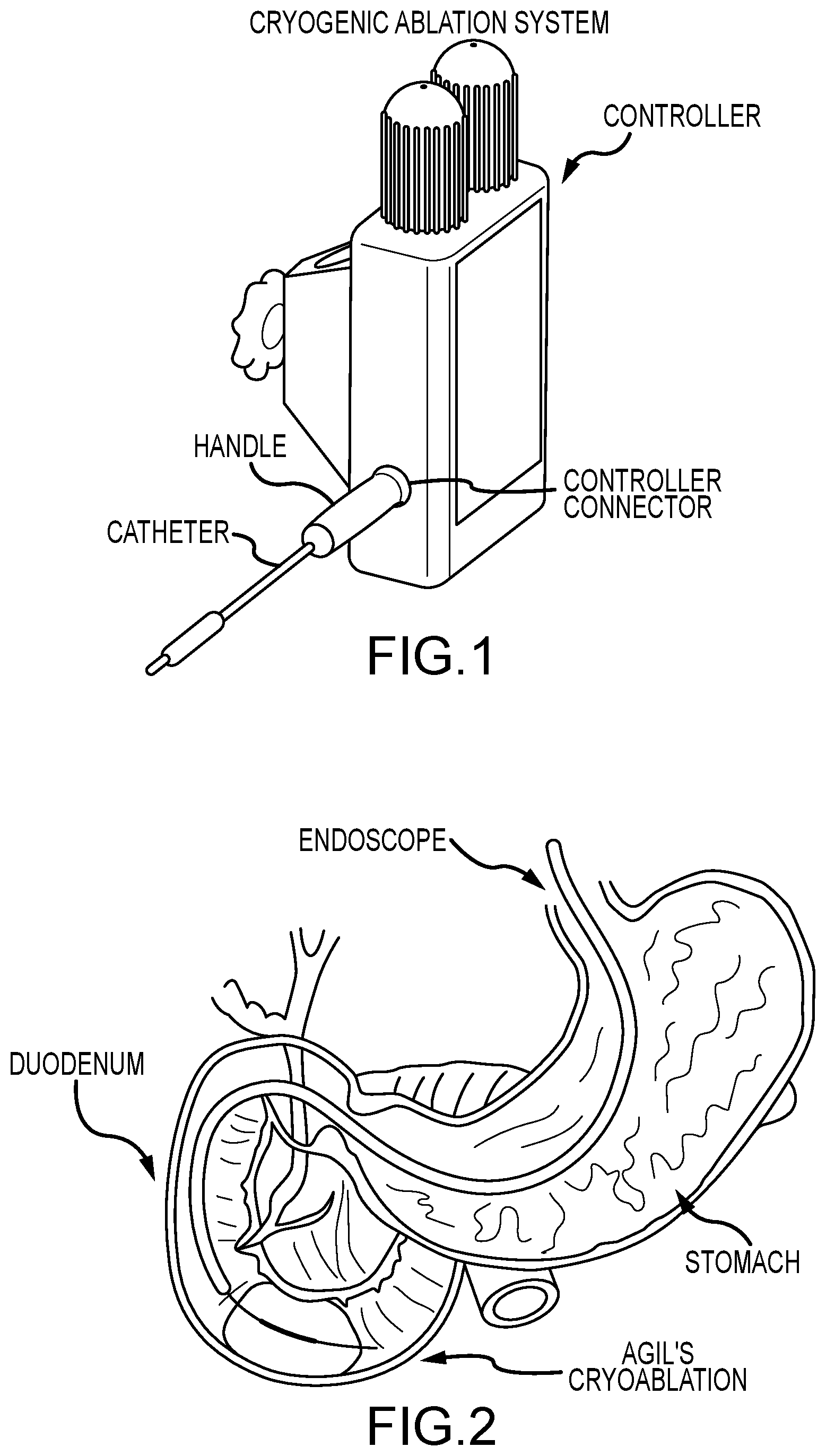 Patent US12599424 Figure 1 – Cryogenic catheter probe, system, and method for selective ablation of mucosa and submucosa of the gastrointestinal tract