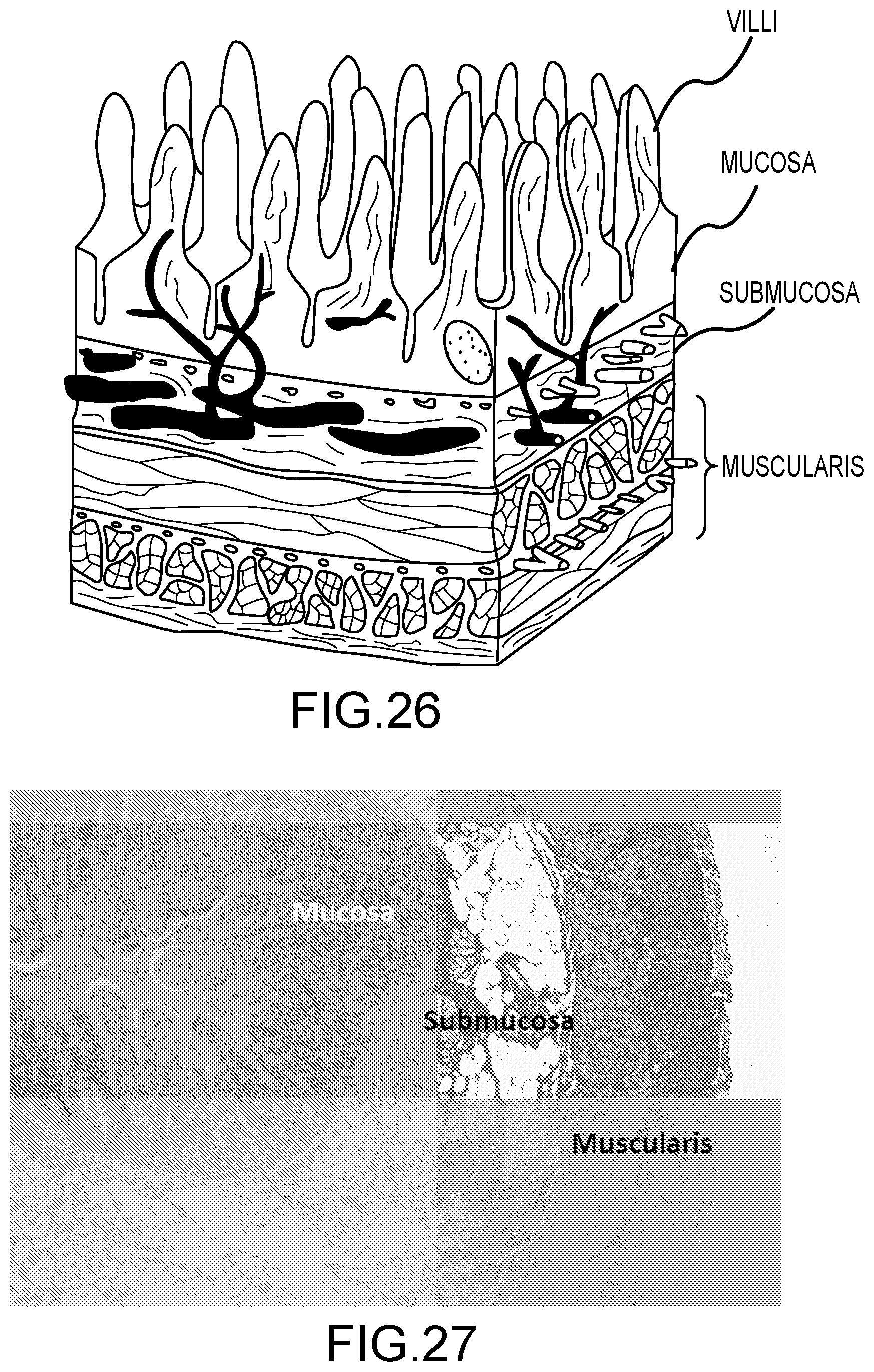 Patent US12599424 Figure 20 – Cryogenic catheter probe, system, and method for selective ablation of mucosa and submucosa of the gastrointestinal tract