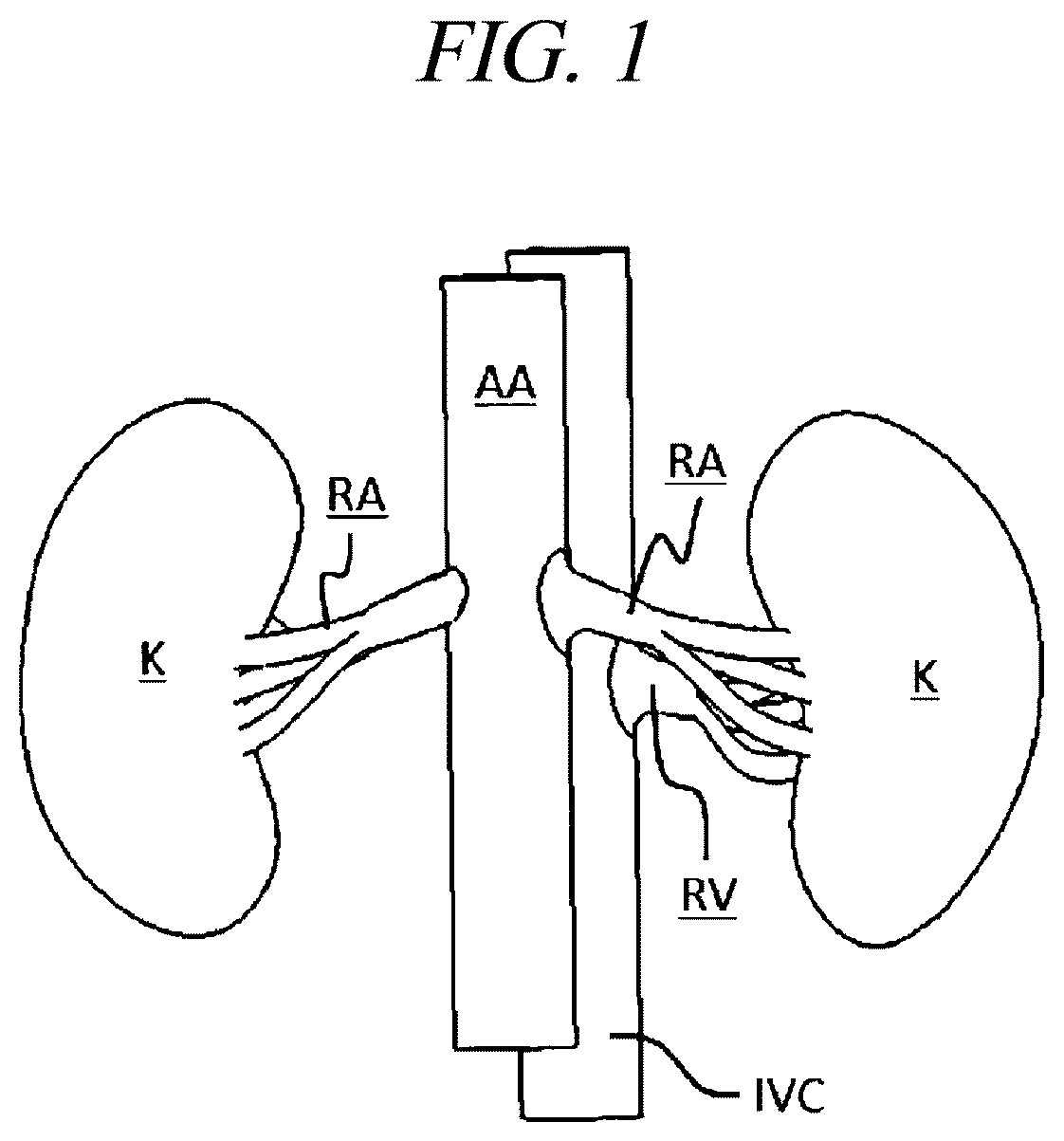 Patent US12599425 Figure 1 – Systems for perivascular nerve denervation