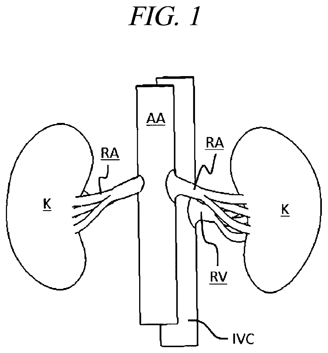 Patent US12599430 Figure 1 – Systems and methods for perivascular nerve denervation