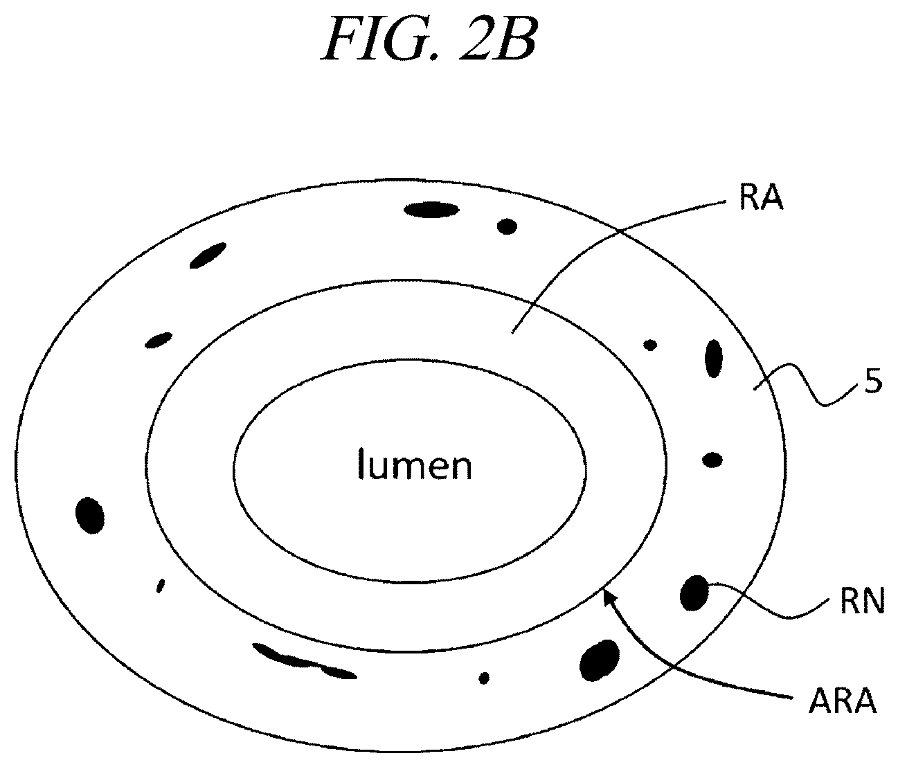 Patent US12599430 Figure 3 – Systems and methods for perivascular nerve denervation