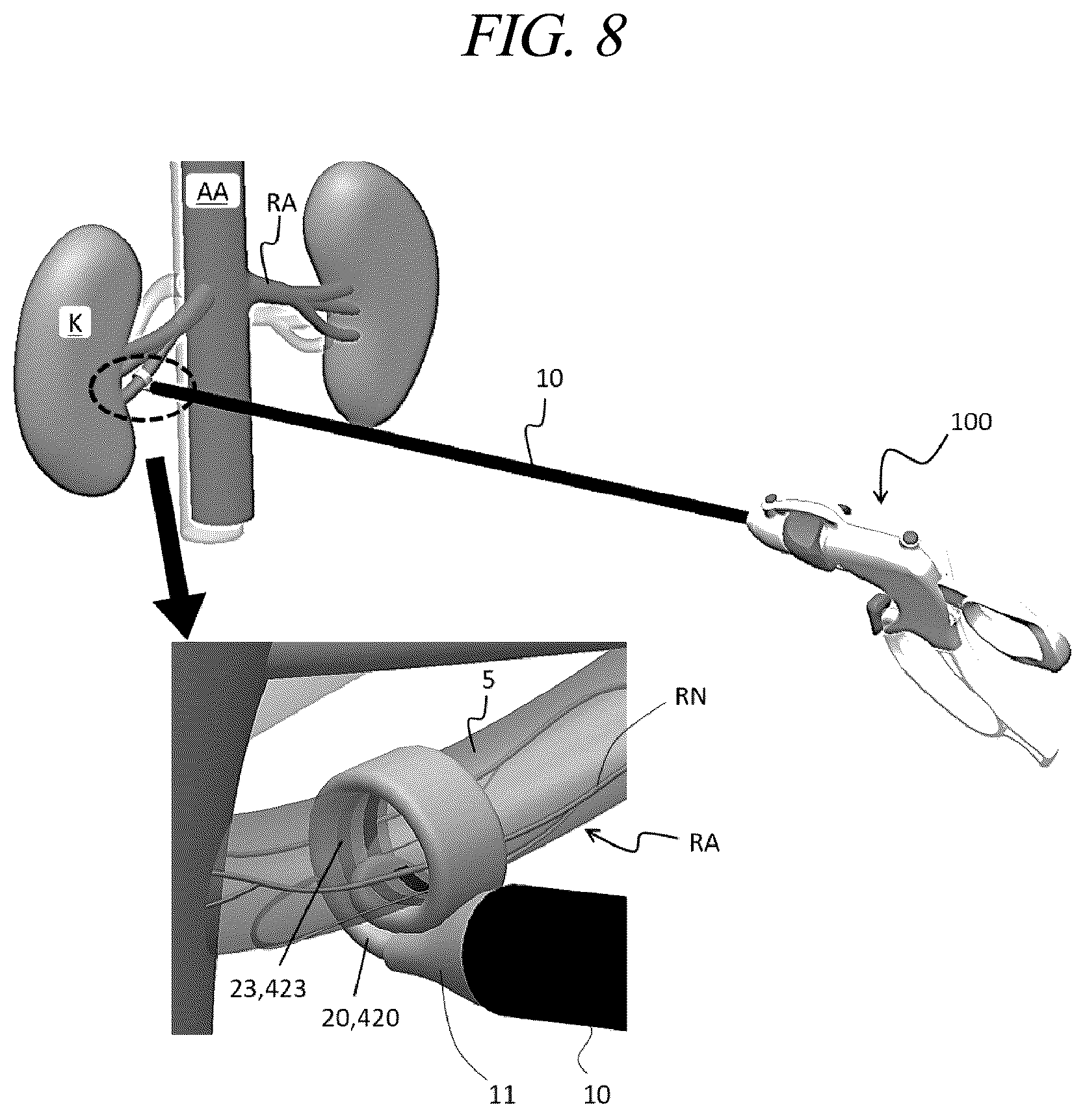 Patent US12599430 Figure 15 – Systems and methods for perivascular nerve denervation