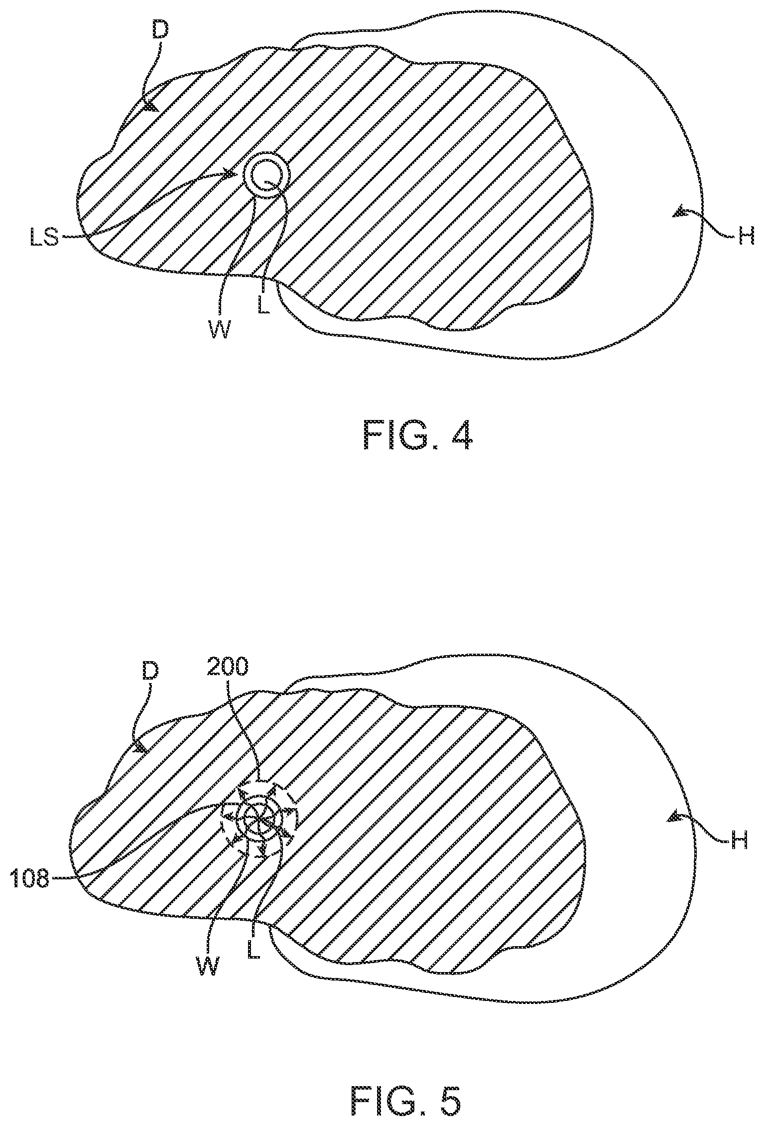 Patent US12599432 Figure 11 – Devices, systems and methods for the treatment of abnormal tissue