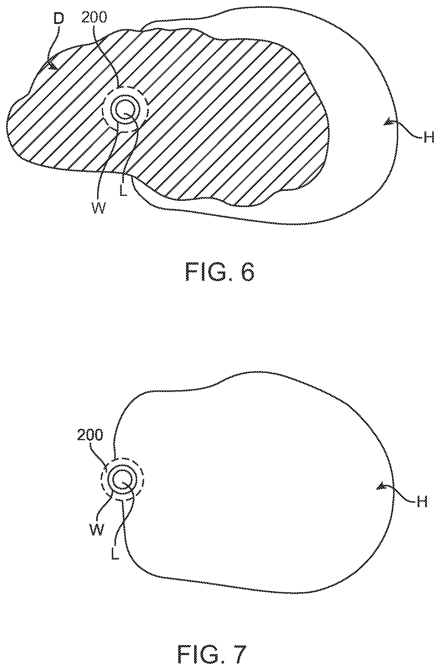 Patent US12599432 Figure 12 – Devices, systems and methods for the treatment of abnormal tissue