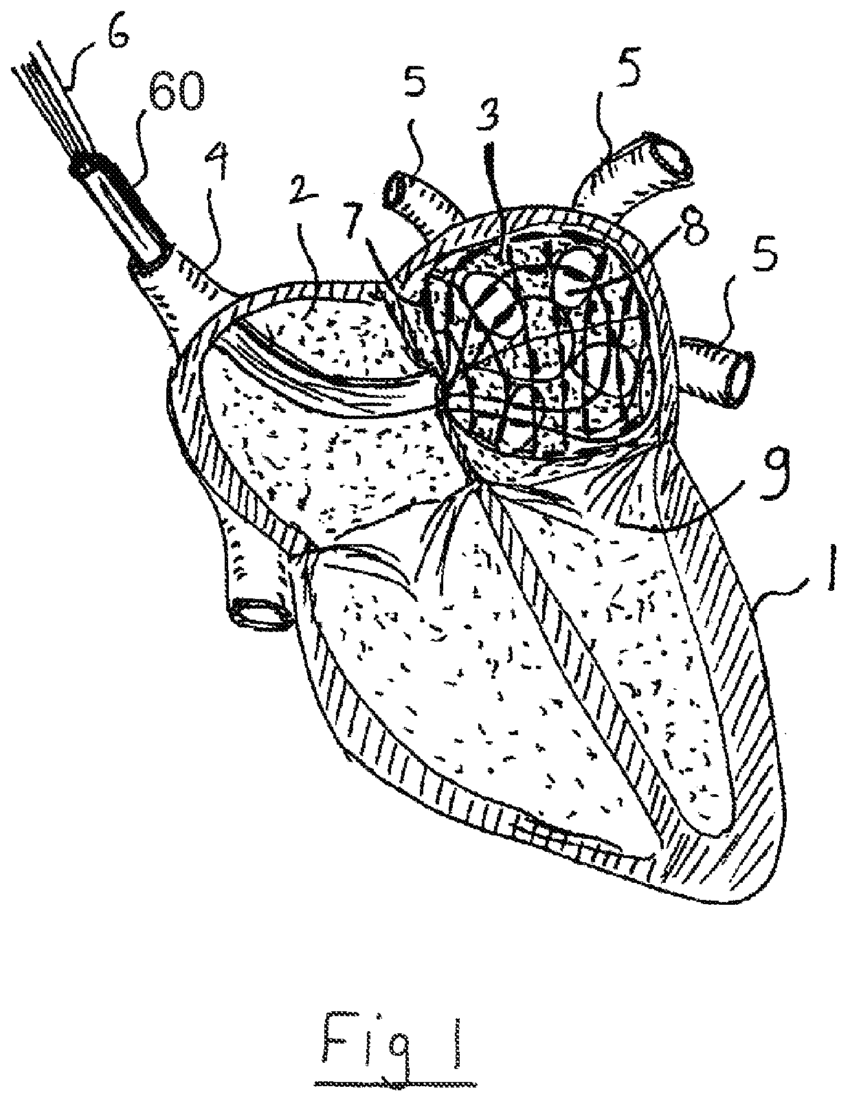 Patent US12599433 Figure 1 – Apparatus and method for intra-cardiac mapping and ablation