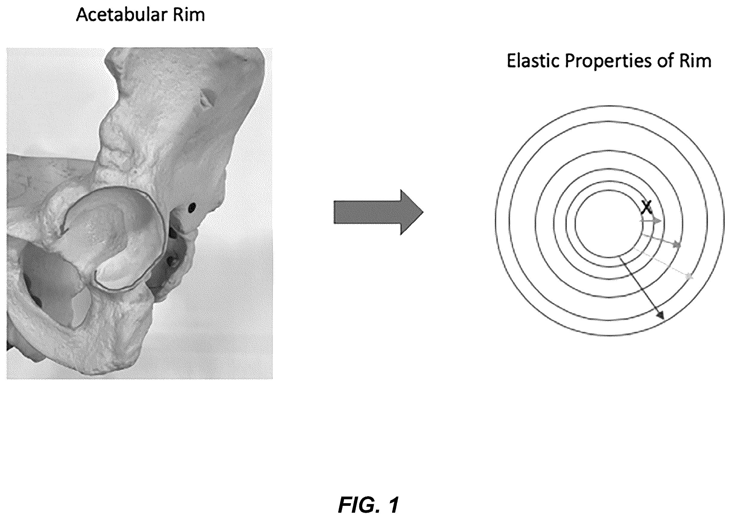 Patent US12599455 — Electronic signature for bone preparation — Figure 1