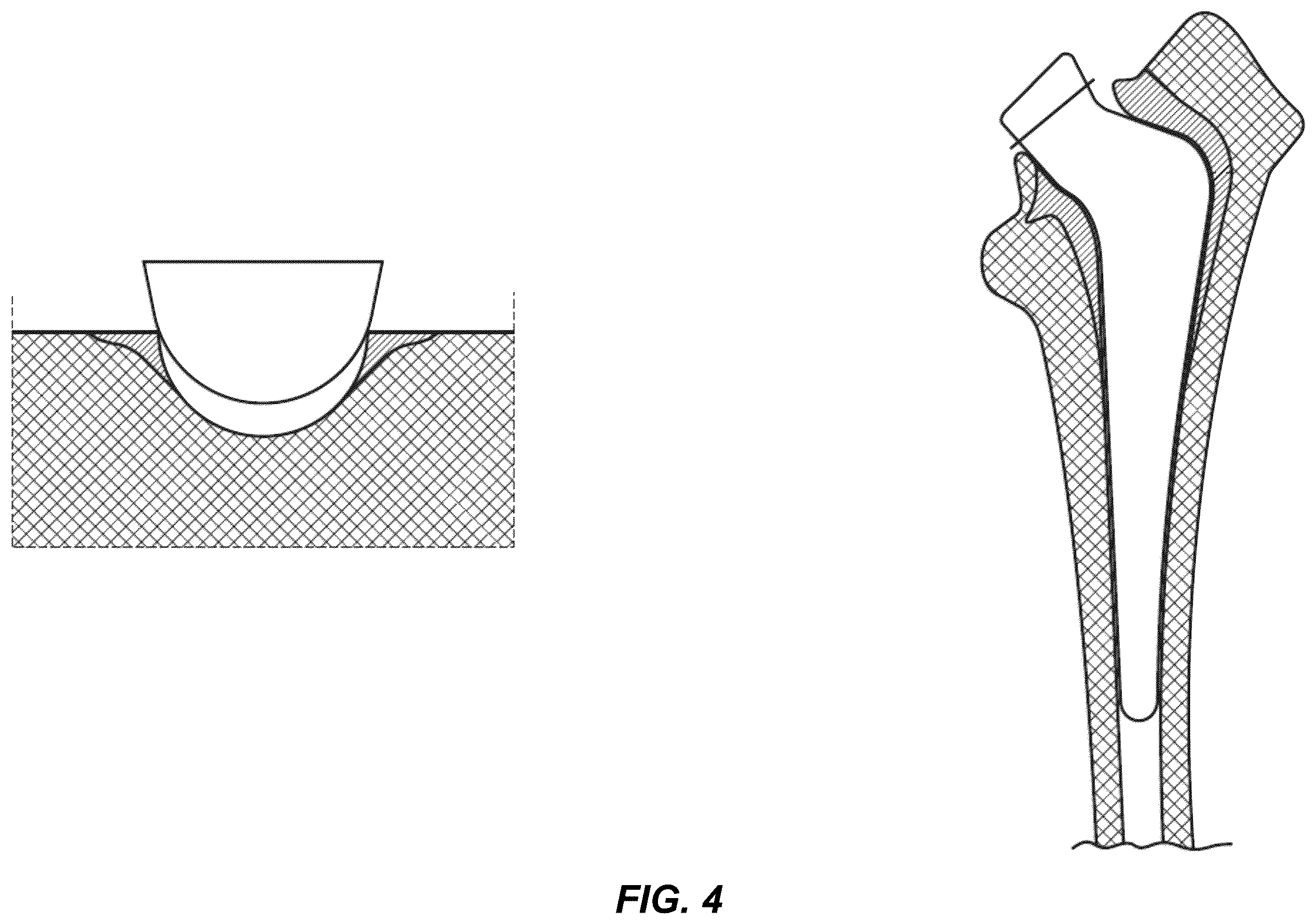 Patent US12599455 Figure 4 – Electronic signature for bone preparation