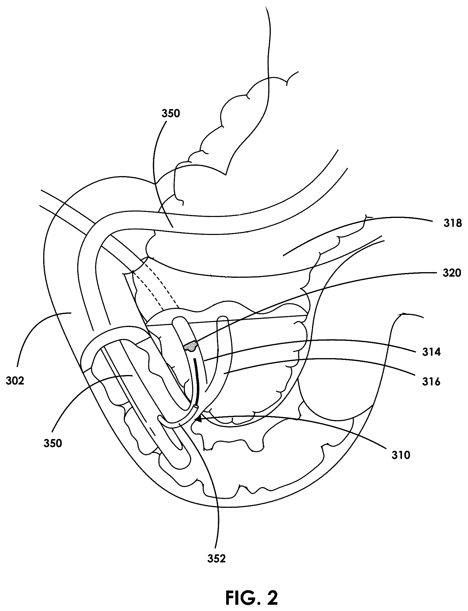 Patent US12599457 Figure 2 – Mixed reality endoscopic retrograde cholangiopancreatopgraphy (ERCP) procedure