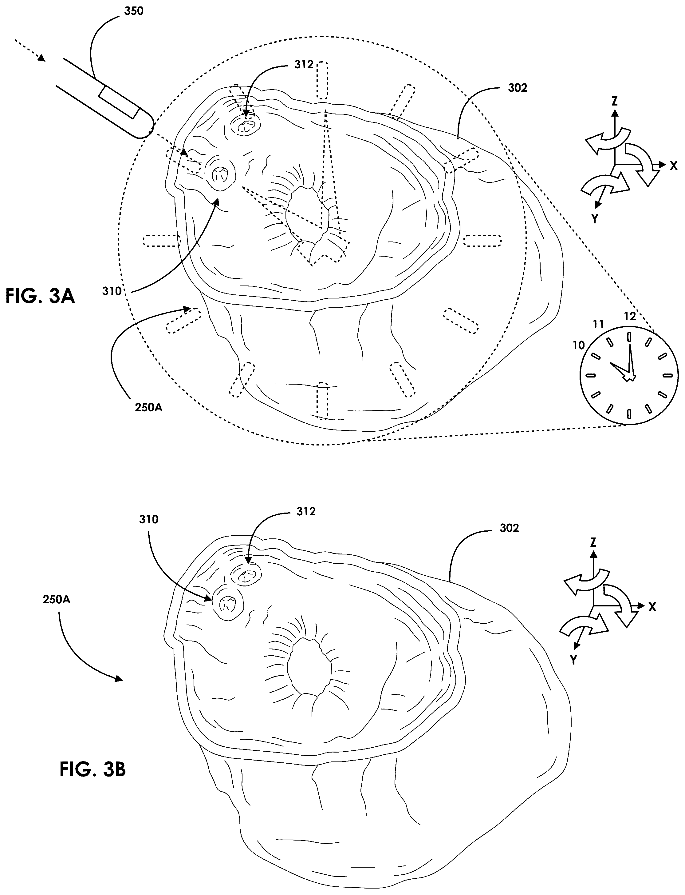 Patent US12599457 Figure 3 – Mixed reality endoscopic retrograde cholangiopancreatopgraphy (ERCP) procedure