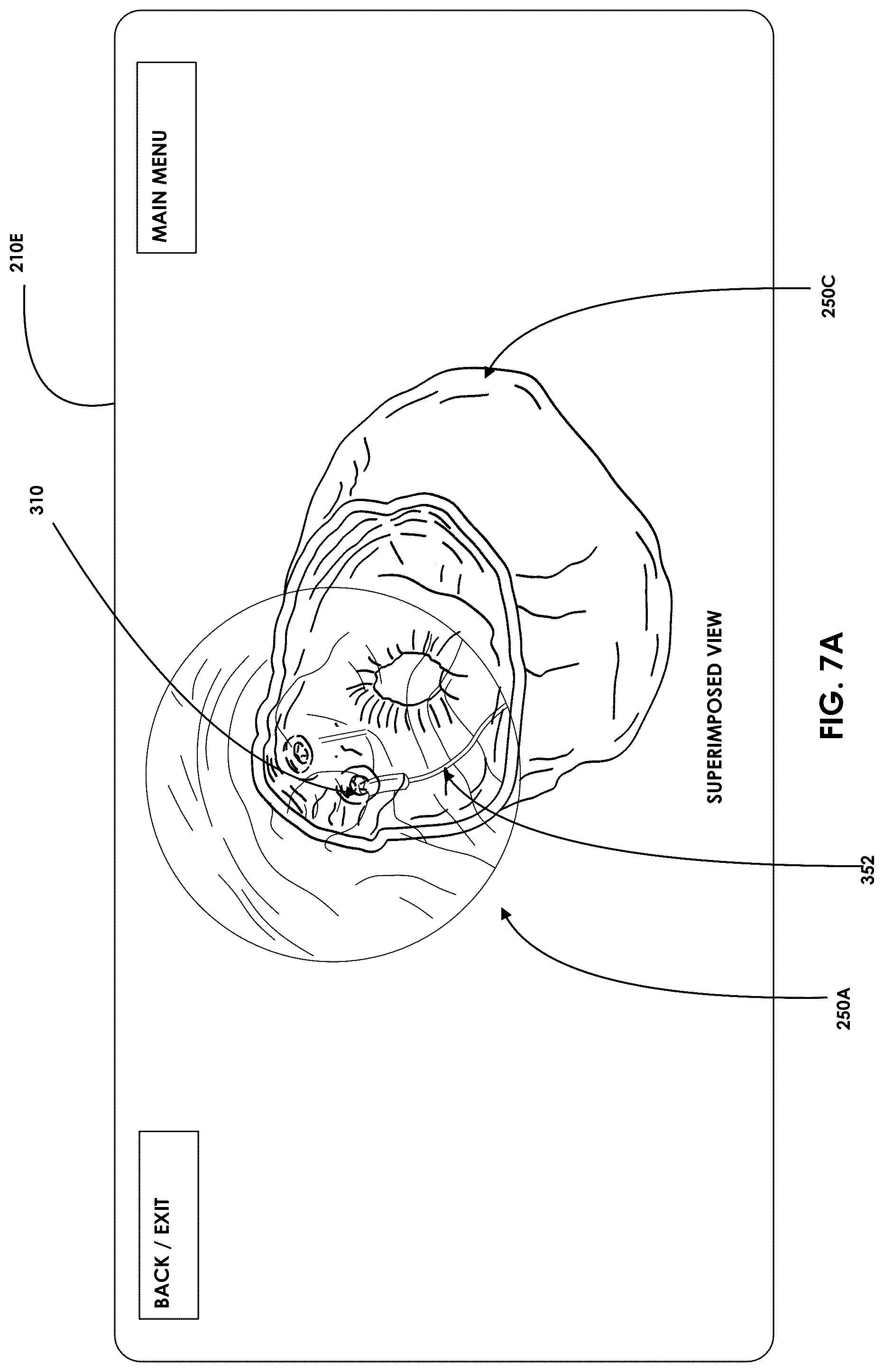 Patent US12599457 Figure 7 – Mixed reality endoscopic retrograde cholangiopancreatopgraphy (ERCP) procedure