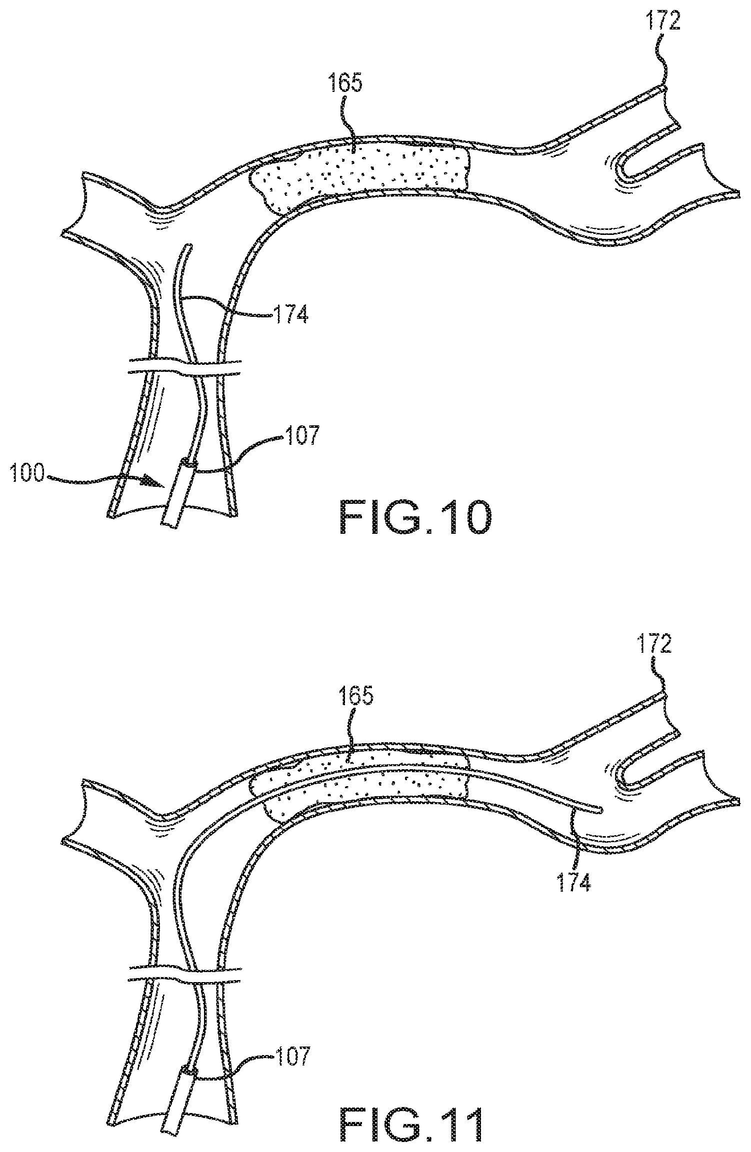 Patent US12599458 Figure 8 – Vascular device marker attachment