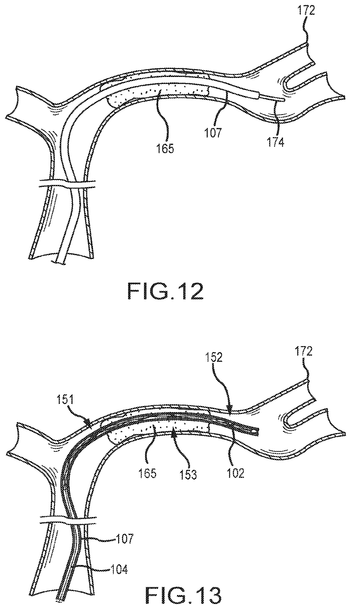 Patent US12599458 Figure 9 – Vascular device marker attachment