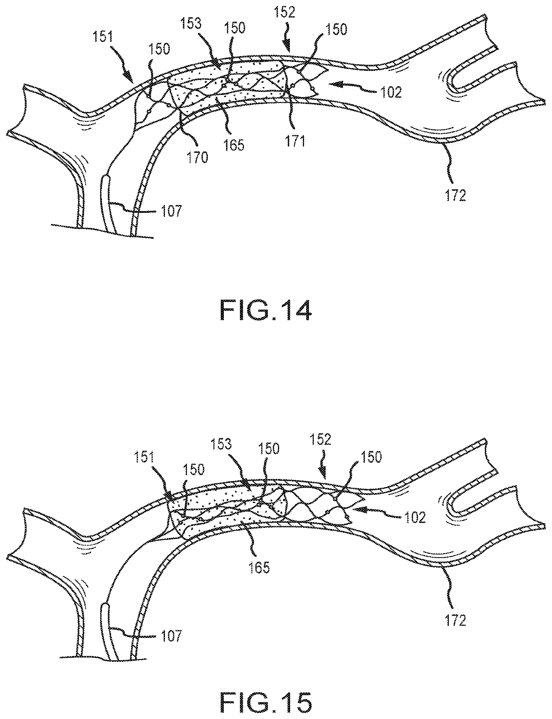 Patent US12599458 Figure 10 – Vascular device marker attachment