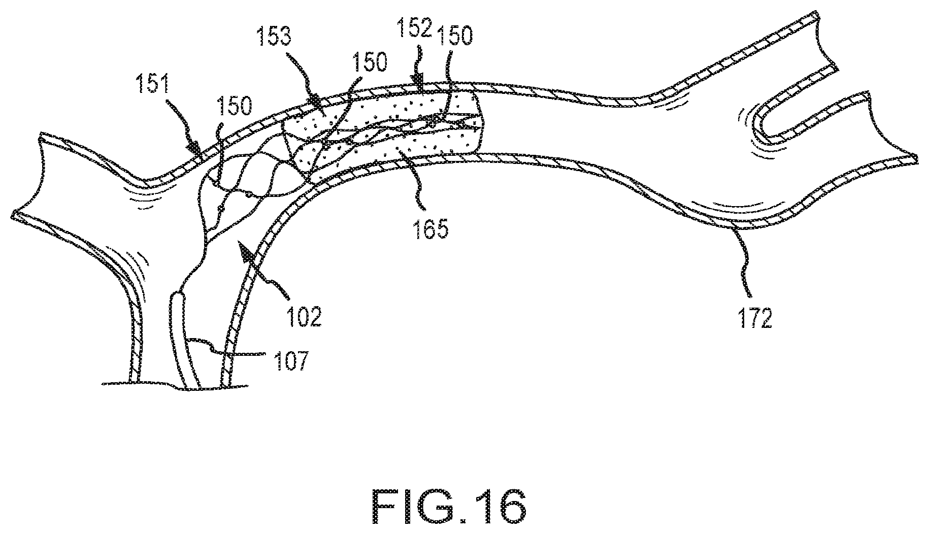 Patent US12599458 Figure 11 – Vascular device marker attachment