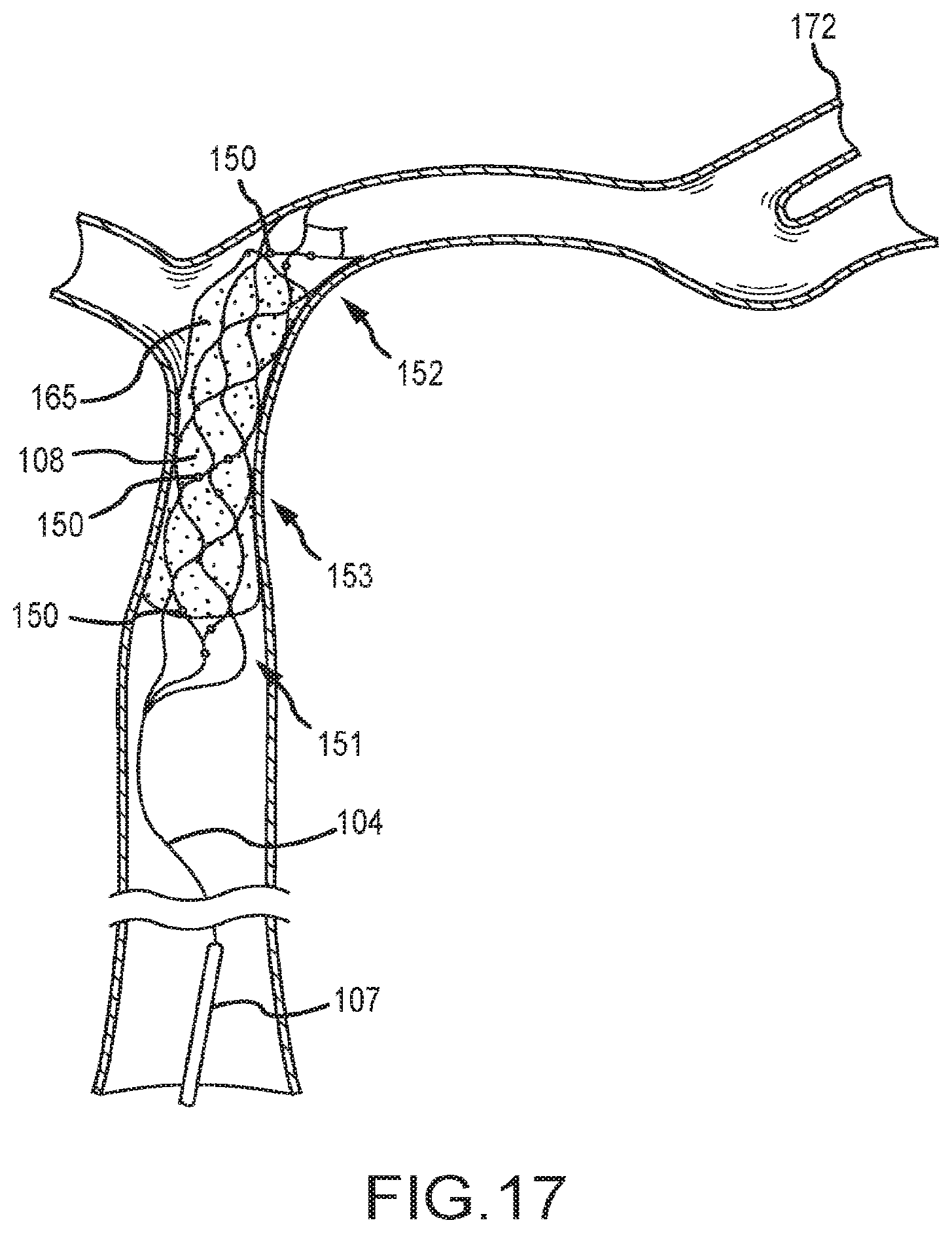 Patent US12599458 Figure 12 – Vascular device marker attachment